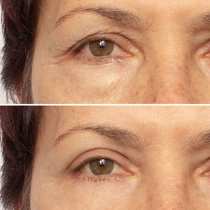 ptosis correction